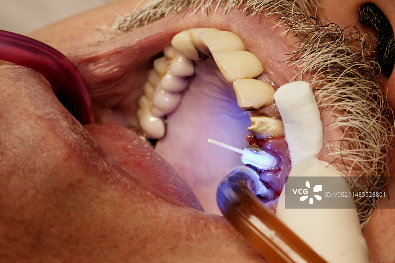 牙科治疗图片素材