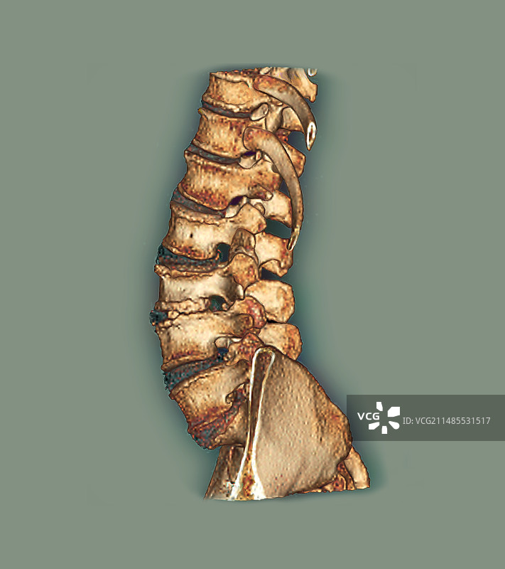 脊柱关节炎CT扫描图片素材