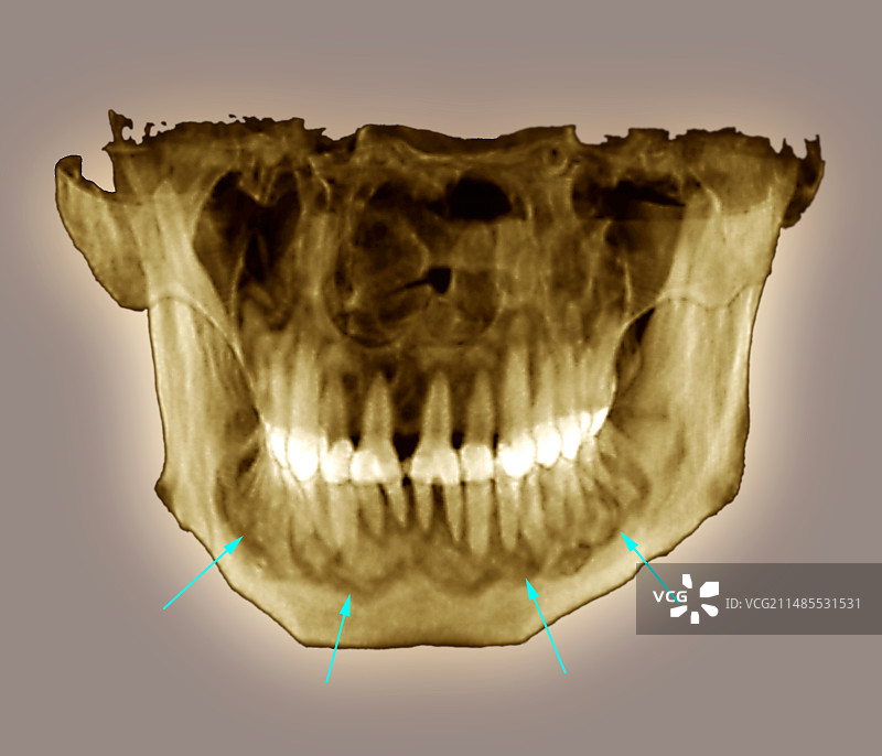牙骨质发育不良CT扫描图片素材