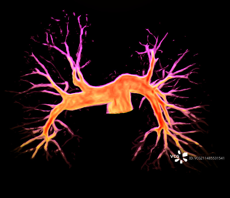 肺动脉核磁共振扫描图片素材