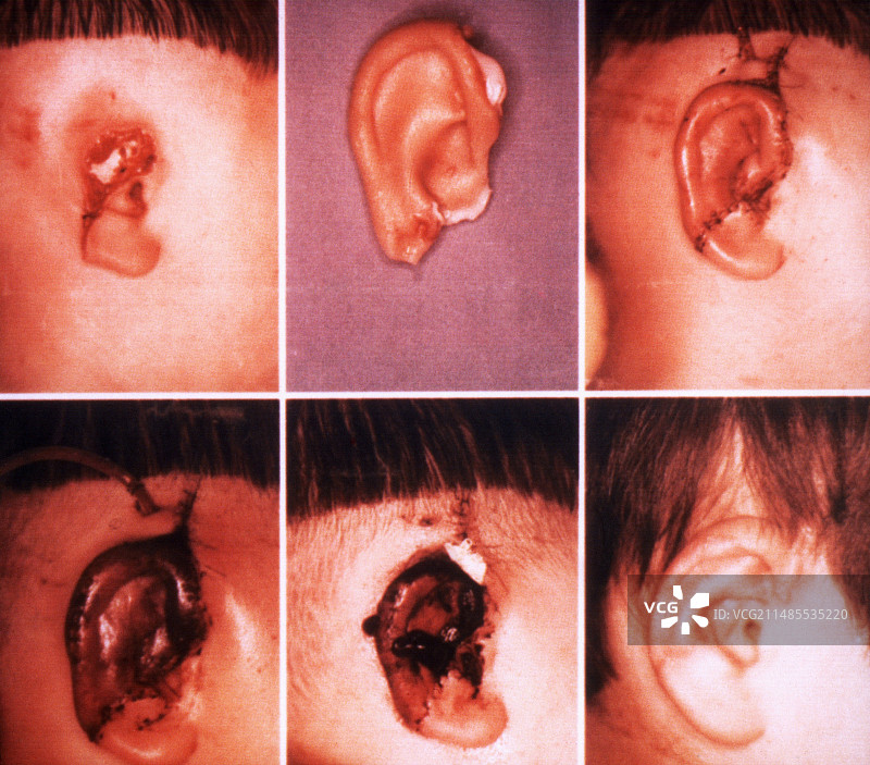 耳朵再植手术图片素材