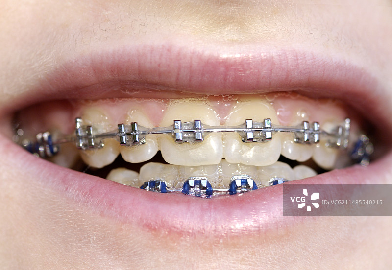 牙齿矫正器图片素材