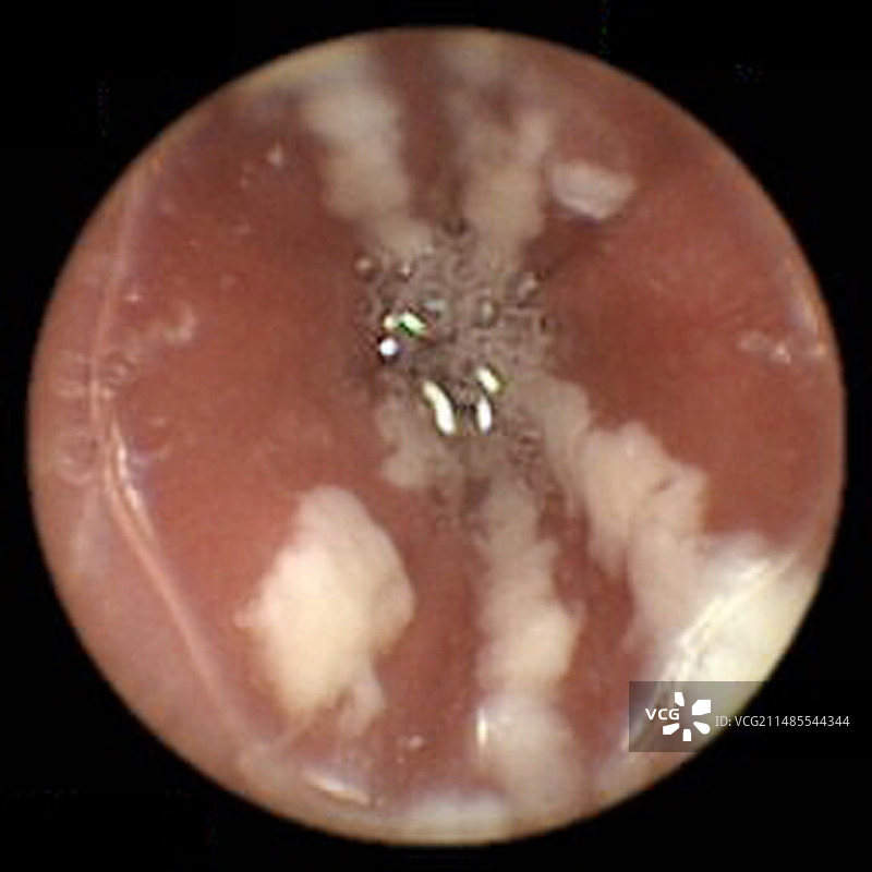 食道念珠菌病，胶囊内窥镜观察图片素材