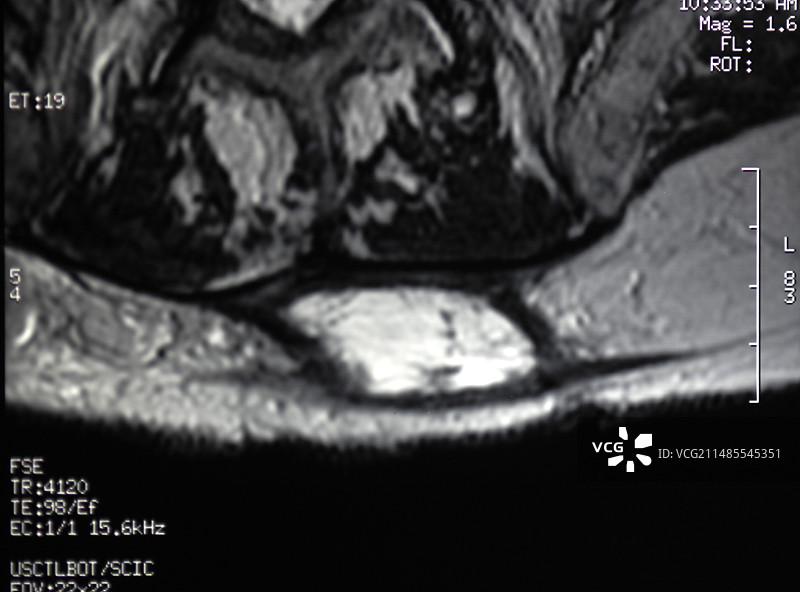 血肿核磁共振扫描图片素材