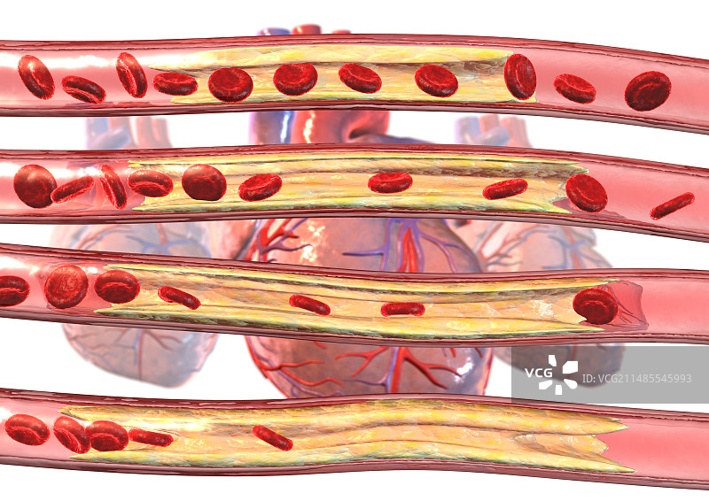 冠状动脉疾病图片素材