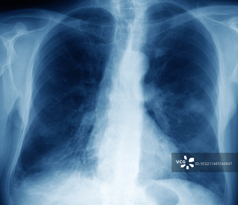 肺癌X光片图片素材