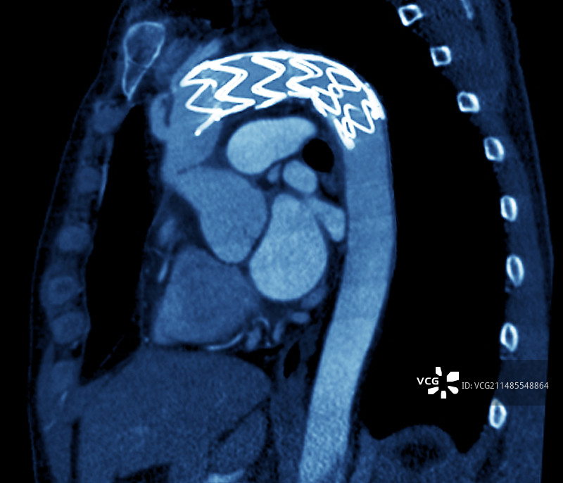 CT扫描：主动脉夹层中的支架图片素材