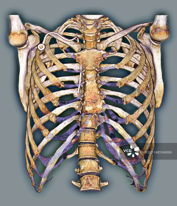 永久性胸腔导管3D CT扫描图片素材