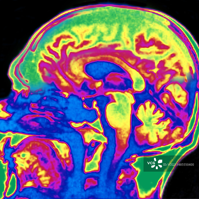 大脑核磁共振扫描图片素材