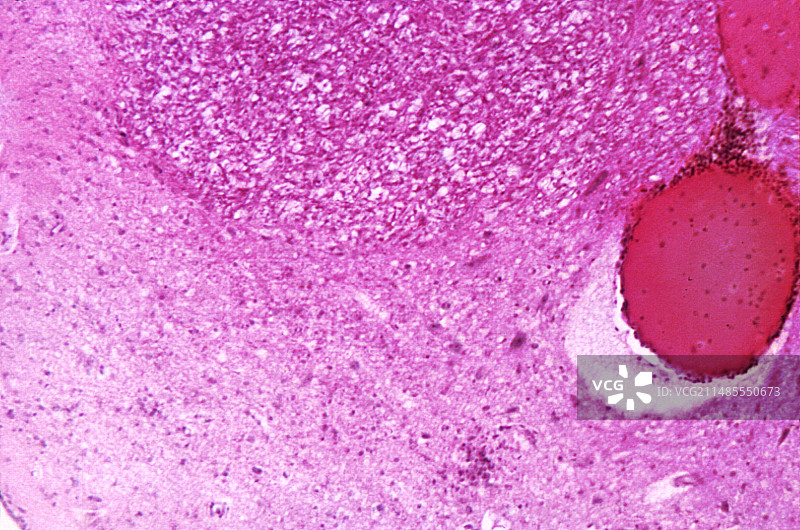 脊髓灰质炎影响的脑干图片素材