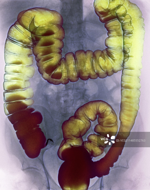 大肠X光片图片素材