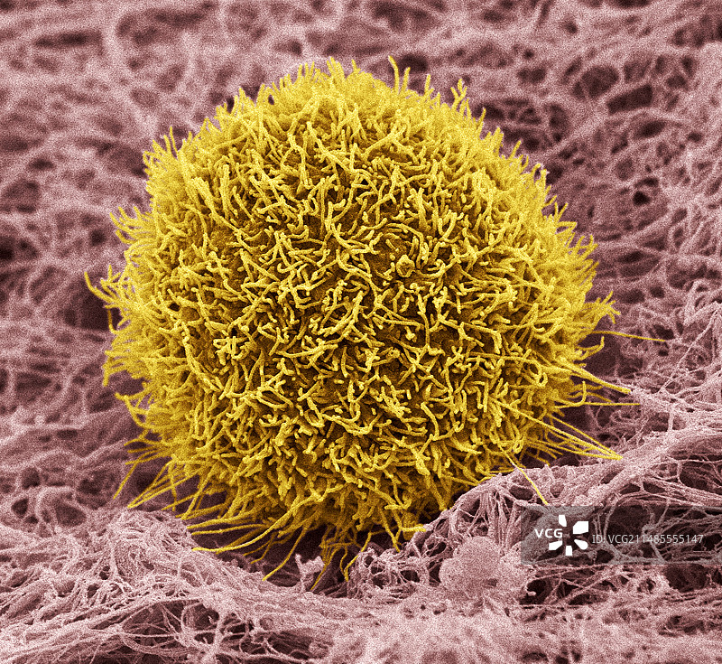 皮肤癌细胞，扫描电子显微镜图片素材