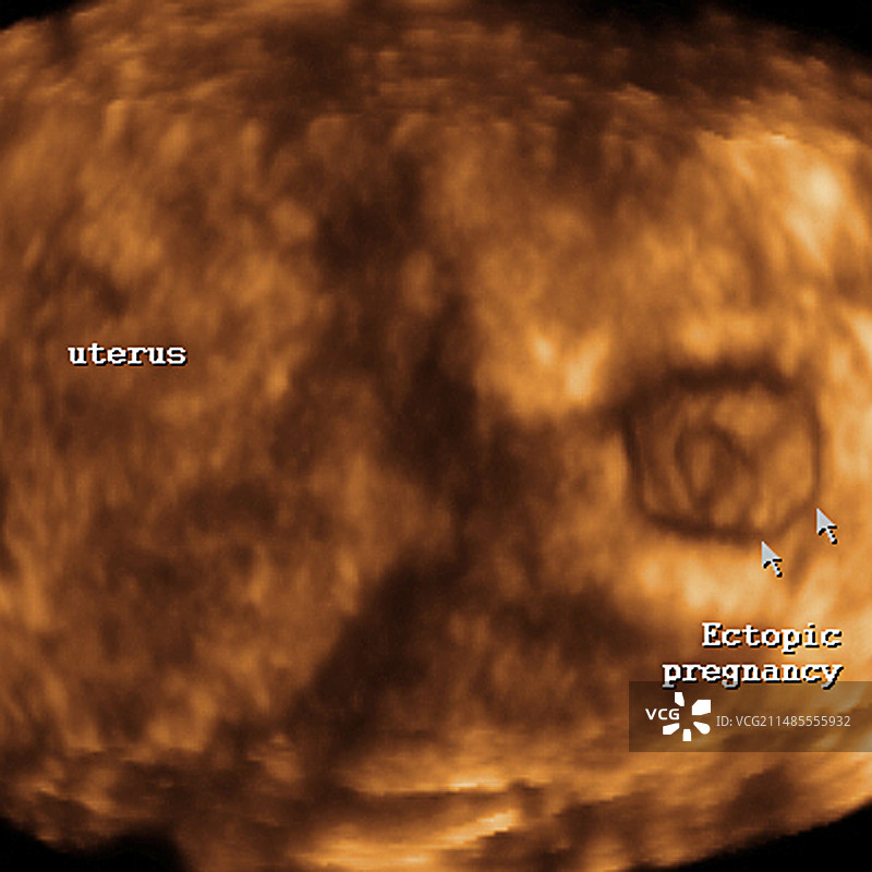 异位妊娠超声波扫描图片素材