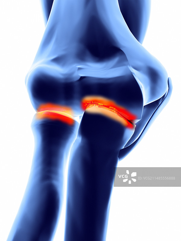 关节炎肘部图片素材