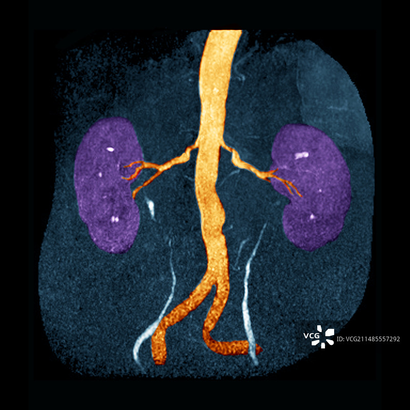 肾动脉狭窄的核磁共振扫描图片素材