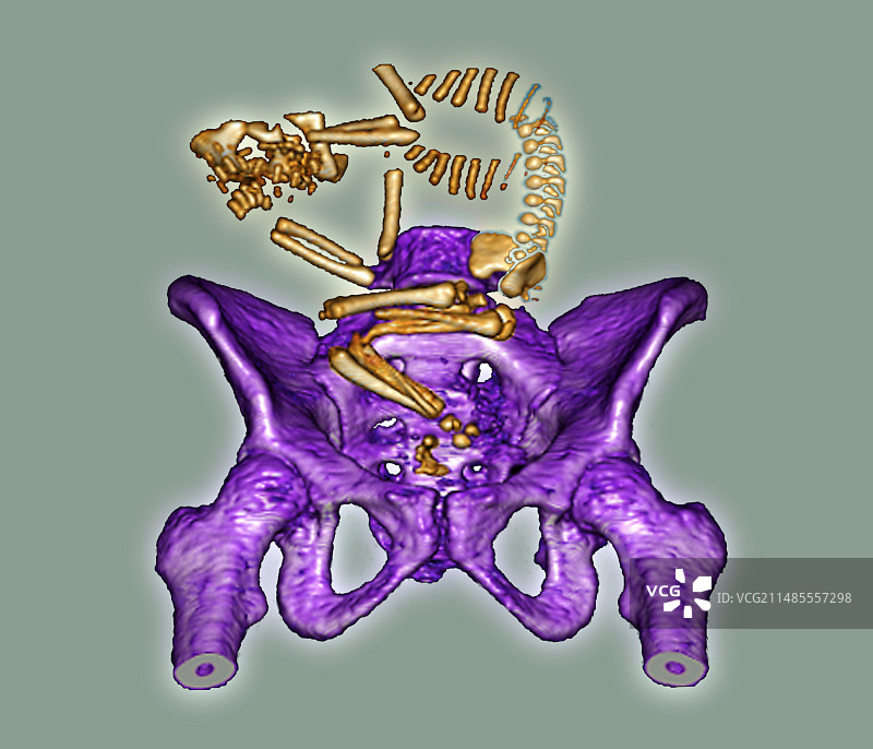 臀位胎儿的CT扫描图片素材