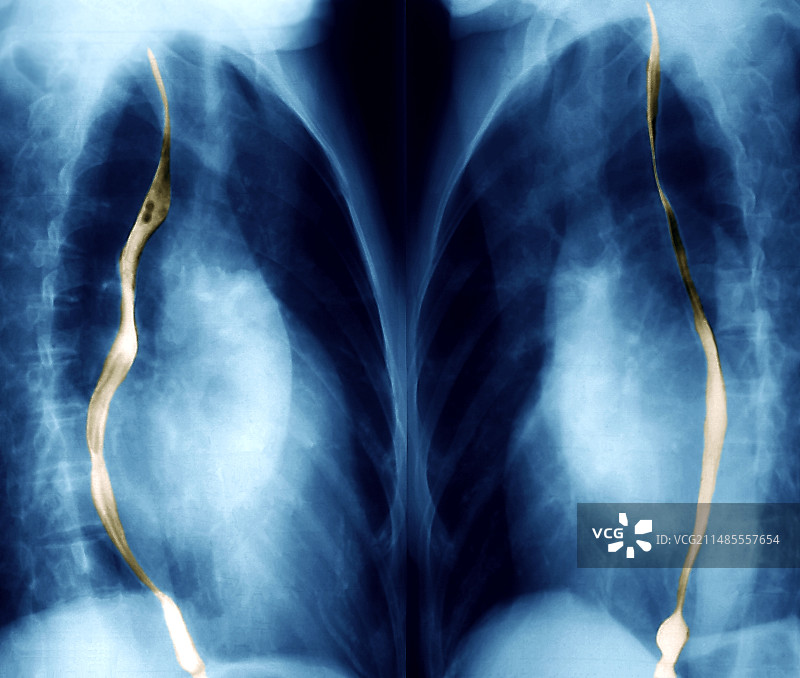 心脏扩大X光片图片素材