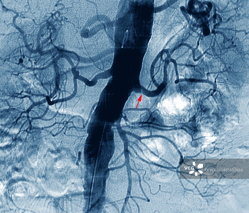 肾动脉狭窄X光片图片素材
