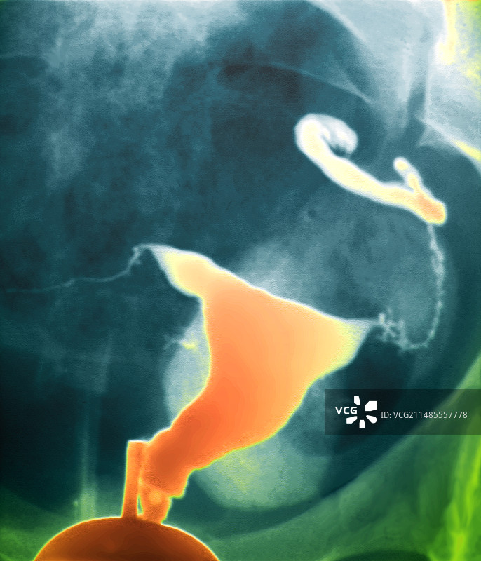 输卵管肿胀X光片图片素材
