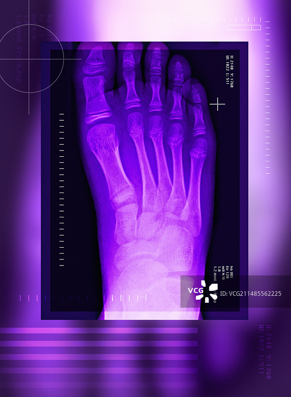 手术后的拇囊炎X光片图片素材