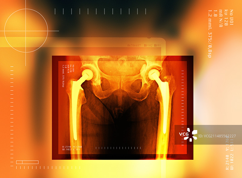 双侧髋关节置换X光片图片素材