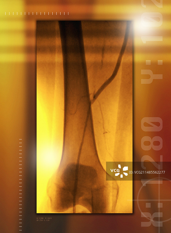 股动脉搭桥术，血管造影X光片图片素材