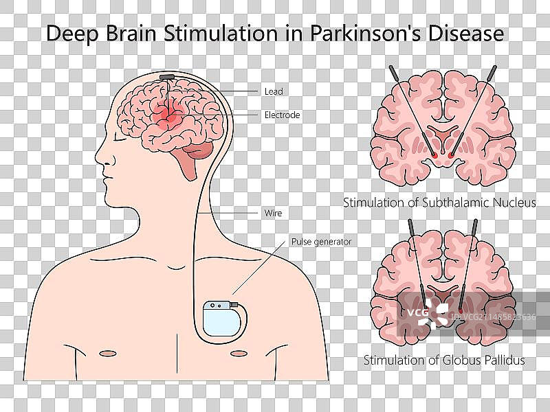 深部脑刺激图医疗科学图片素材
