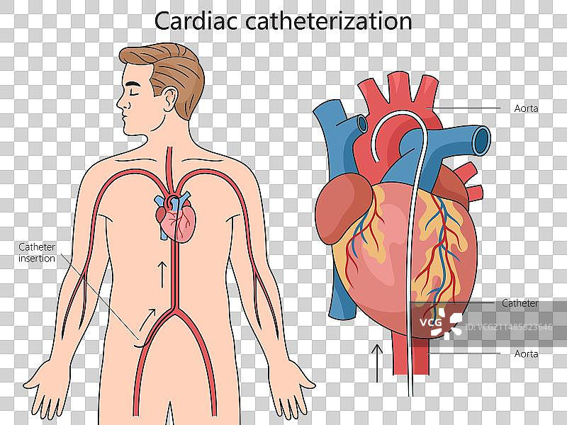 心导管插入术图解医学科学图片素材