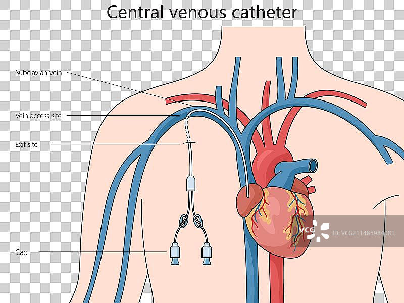 中心静脉导管结构医学图片素材