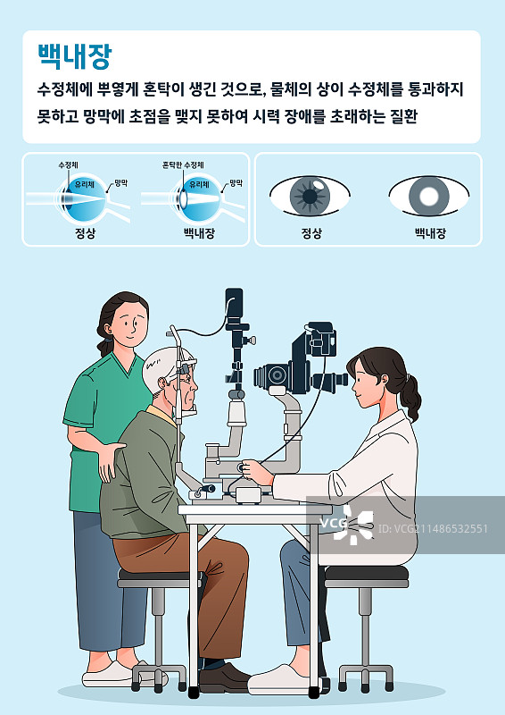 白内障描述与检查图片素材