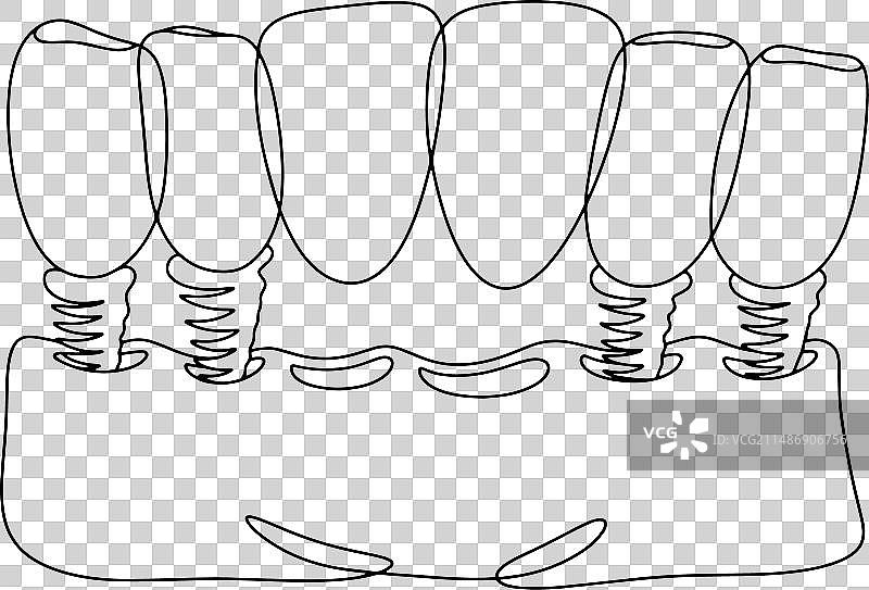 6颗牙齿牙桥线条画图片素材