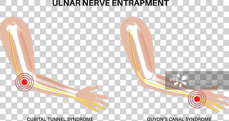 尺神经卡压图片素材