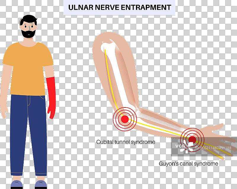 尺神经卡压图片素材