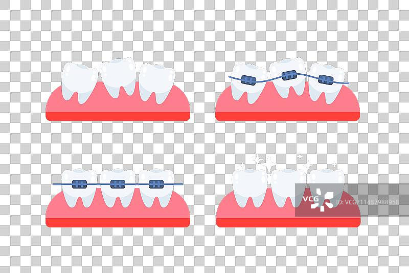 牙齿正畸治疗牙套图片素材