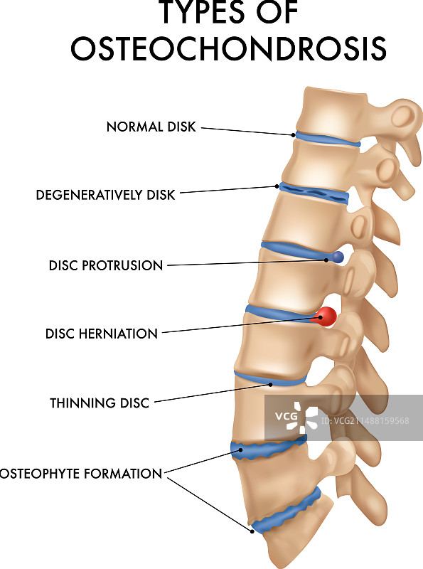 脊柱疝气真实图表图片素材