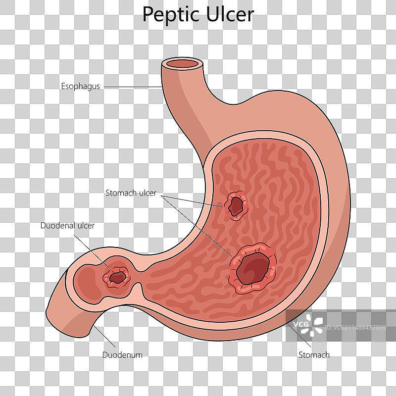 消化性溃疡疾病结构医学图片素材