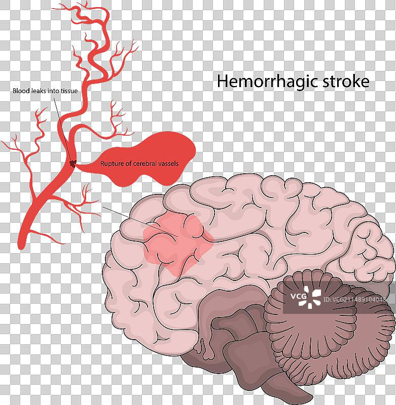 缺血性中风图片素材