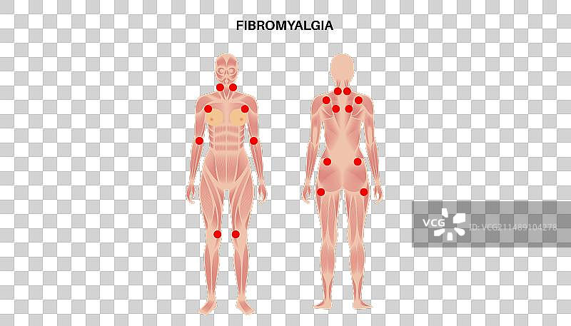 纤维肌痛医疗海报图片素材