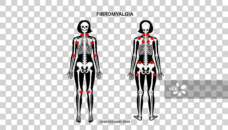 纤维肌痛医疗海报图片素材