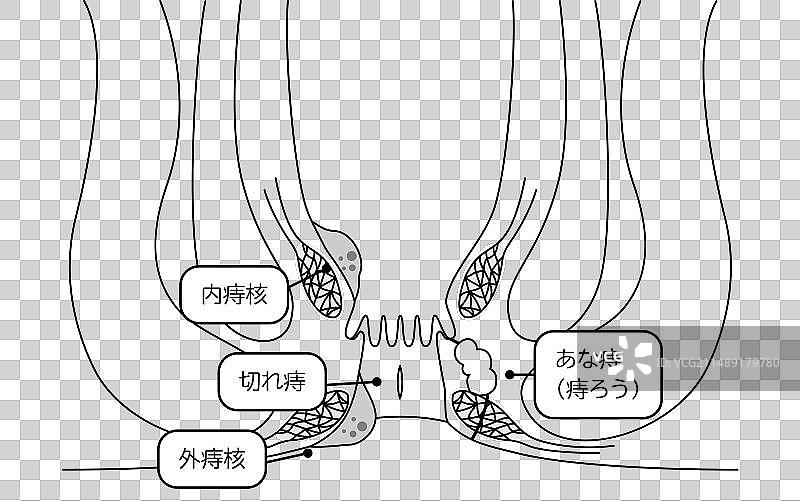 肛门痔疮疣切口疾病图片素材