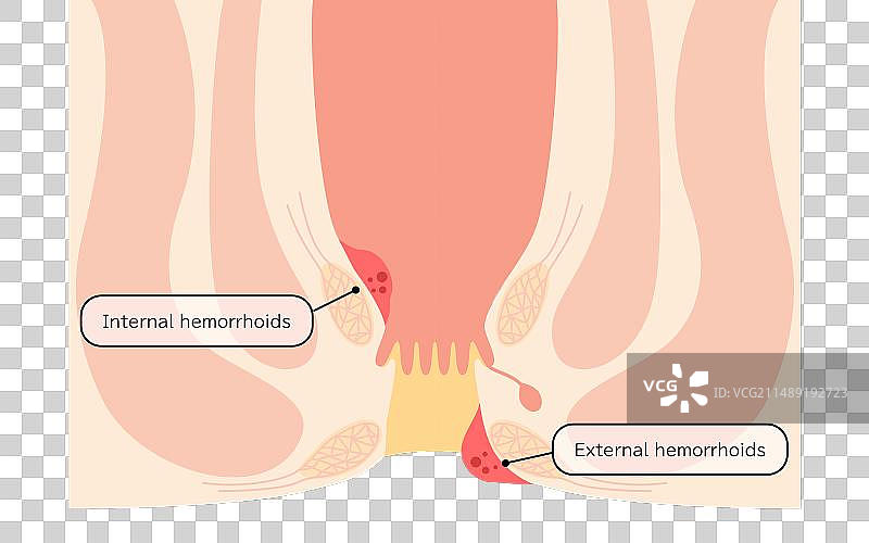 肛门痔疮和疣的疾病图片素材