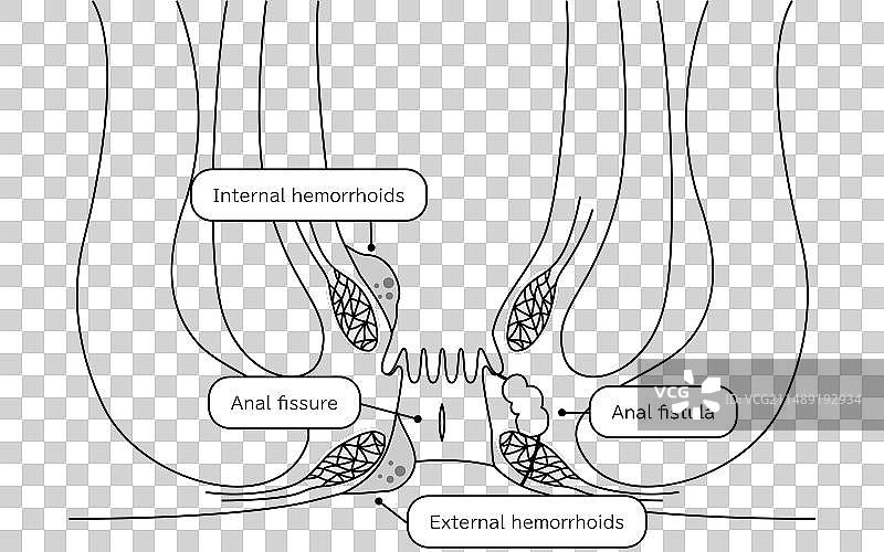 肛门痔疮疣切口疾病图片素材