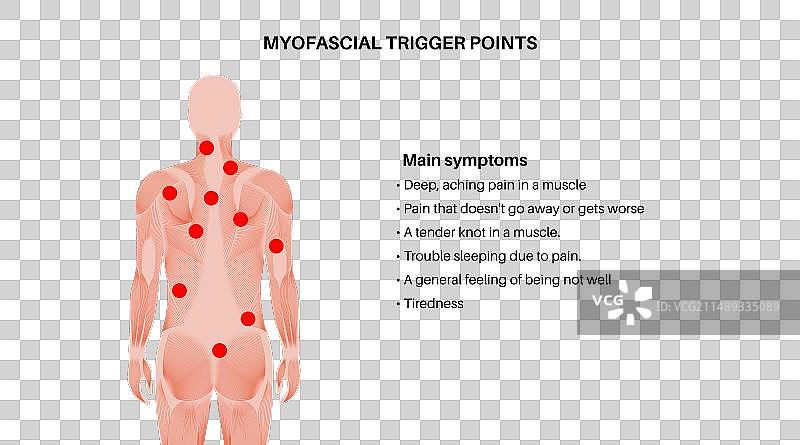 肌筋膜触发点图片素材