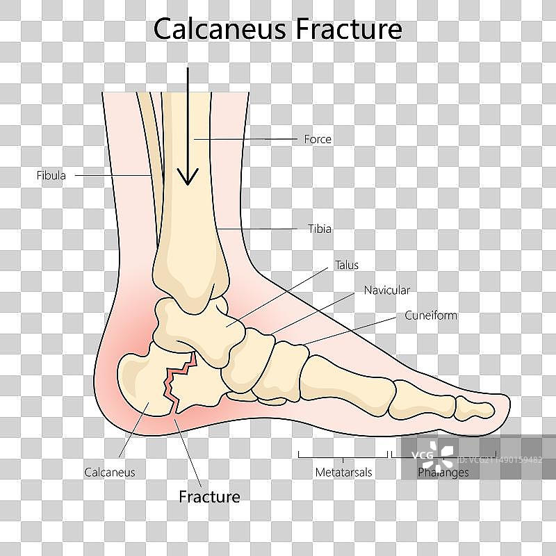 跟骨骨折图医学图片素材