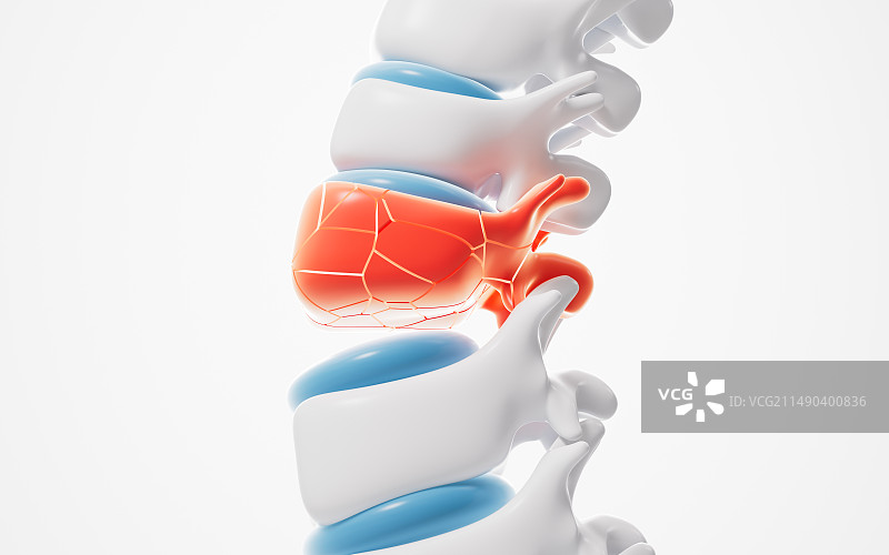 人类脊椎发炎肿胀治疗3D渲染图片素材
