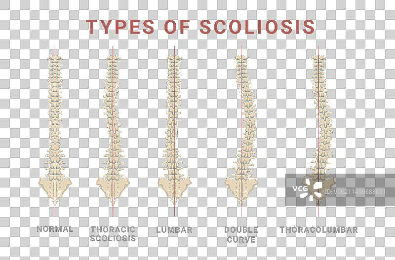 脊柱侧凸分脊柱骨骼正常型和疾病型图片素材