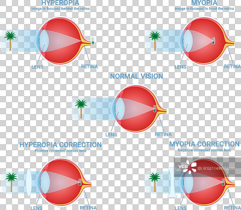 视力缺陷视觉障碍正常近视图片素材