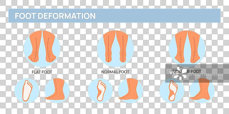 足部畸形医学示意图海报图片素材