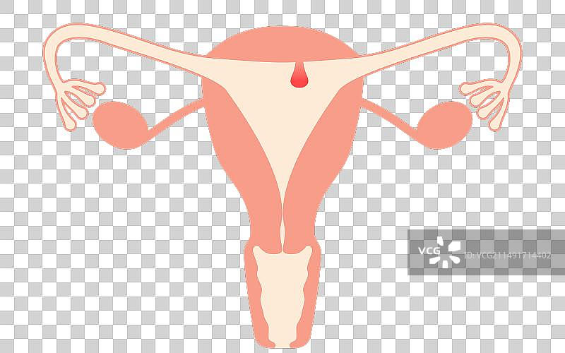 子宫内膜息肉解剖图图片素材