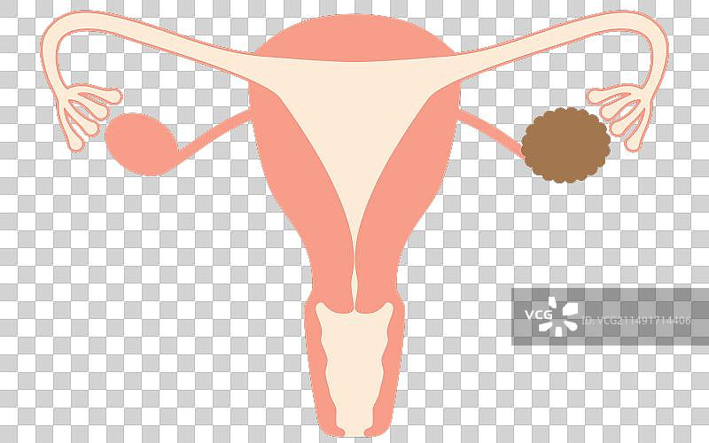 卵巢囊肿解剖示意图图片素材